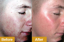 Acne Treatments in Dublin - Get Rid of Acne in 2015