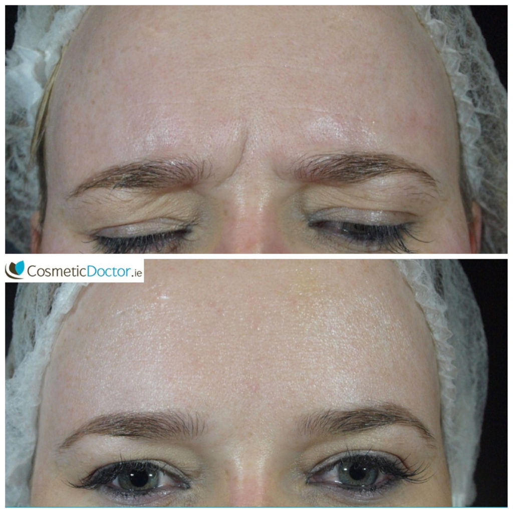botox-frown-lines-ba2