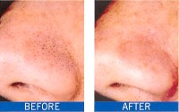 microdermabrasion_gallery02