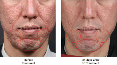Acne Scar Treatment - 34 Days after Treatment