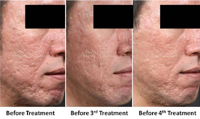 Acne Scar Treatment - Before 4th INTRAcel Treatment