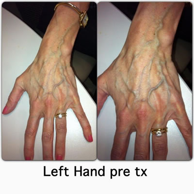 Left Hand Pretreatment
