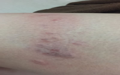 Left Thigh After Treatment - Picture 2