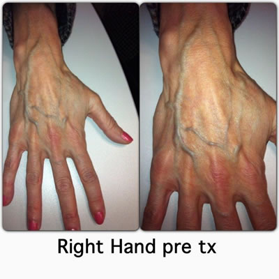 Right Hand Pre-Treatment