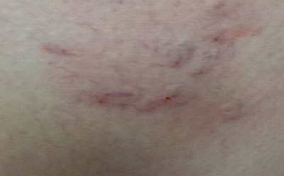 Right Thigh After Treatment