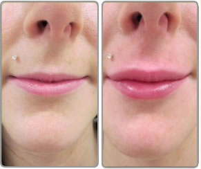 Lip Enhancement Cosmetic Doctor
