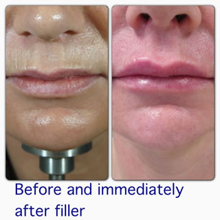 Lip Enhancement in Dublin - Before and Immediately After Treatment