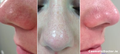 Open Pores and INTRAcel Treatment