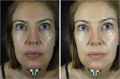 Sian Before and After Dermal Filler Treatment