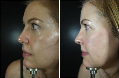 Sian Side of Face Before and After Dermal Filler Treatment