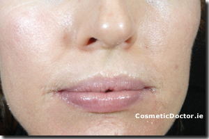 Acne Skin Treatment with ZO Medical - After Treatment Picture