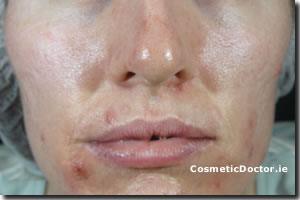 Acne Skin Treatment with ZO Medical - Before Picture