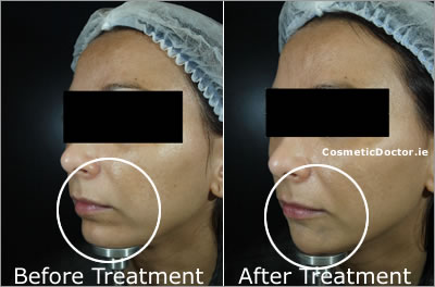 Chin Enhancement with Dermal Filler - Before and After Pictures