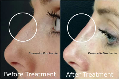 Non-Surgical Nose Reshaping - Case 2