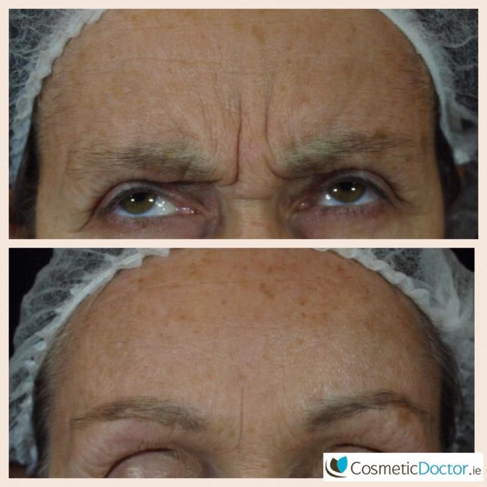 Before after Botox for Frown Lines