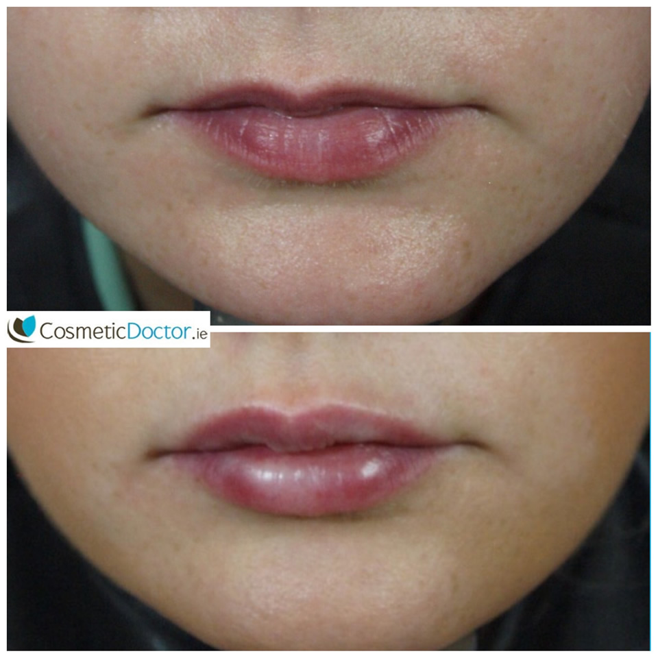 before_and_after_lip_augmentation5