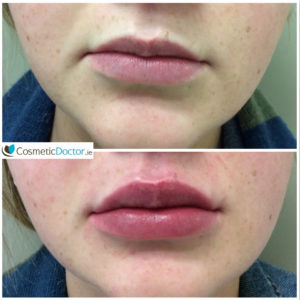 Before after Lip Fillers