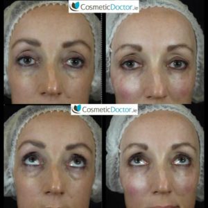 Before and after Tear Trough Treatment with dermal fillers