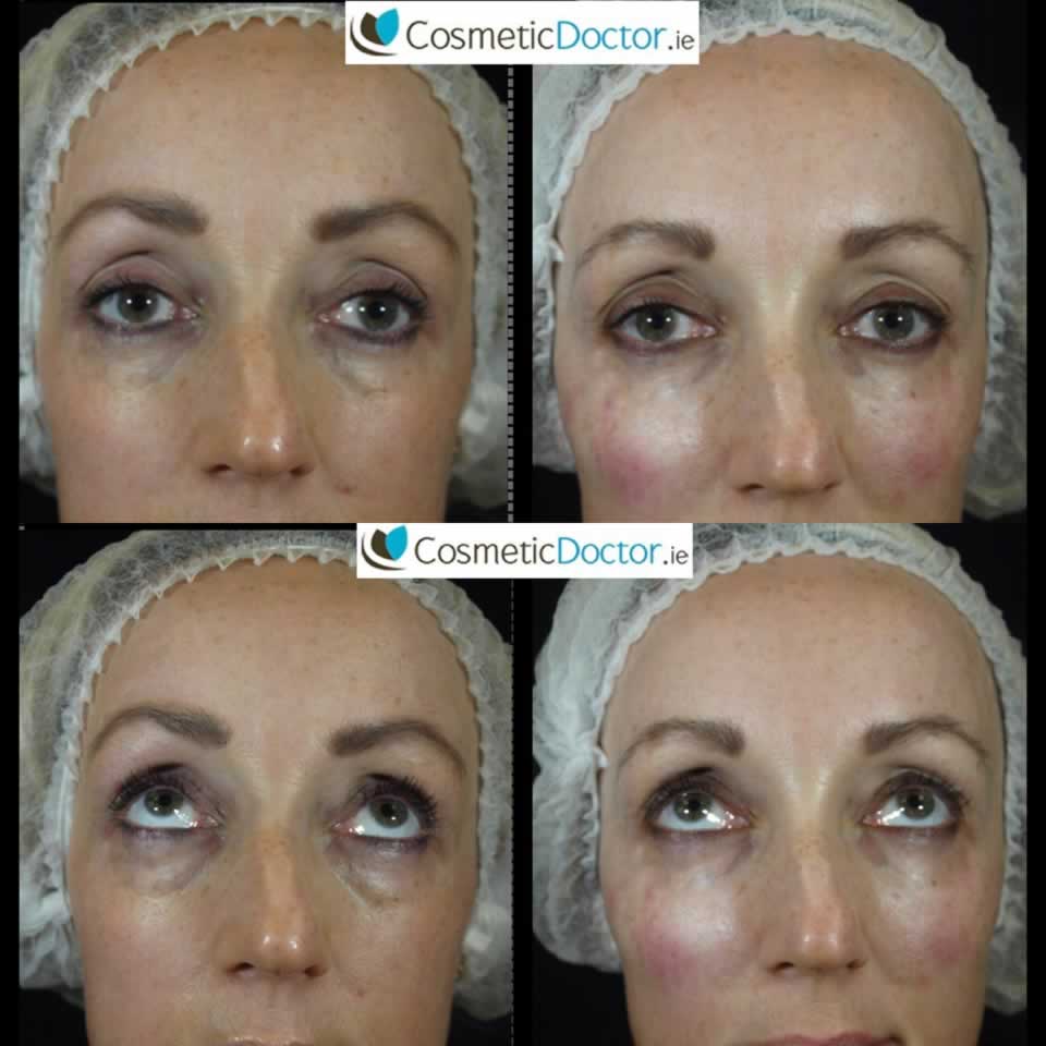 Tear Trough treatment before and after
