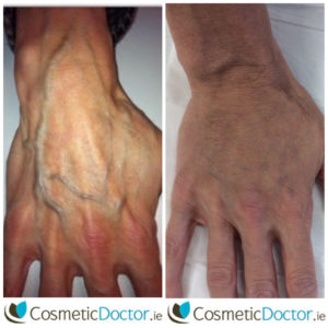 Hand Rejuvenation with Dermal Fillers by Dr Lisa Fay Dublin