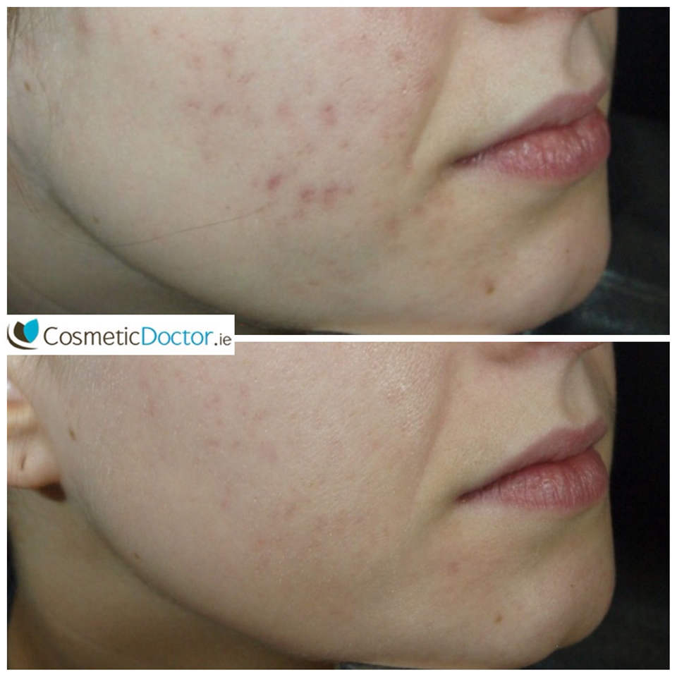 INTRAcel acne treatment before and after photographs