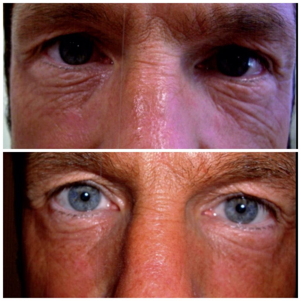 INTRAcel before and after eye tightening treatment- Photos courtesy Dr. John Curran