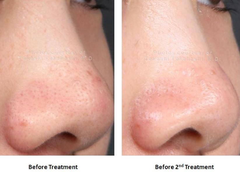 INTRACEL before and after photos of PORES courtesy of INTRACEL