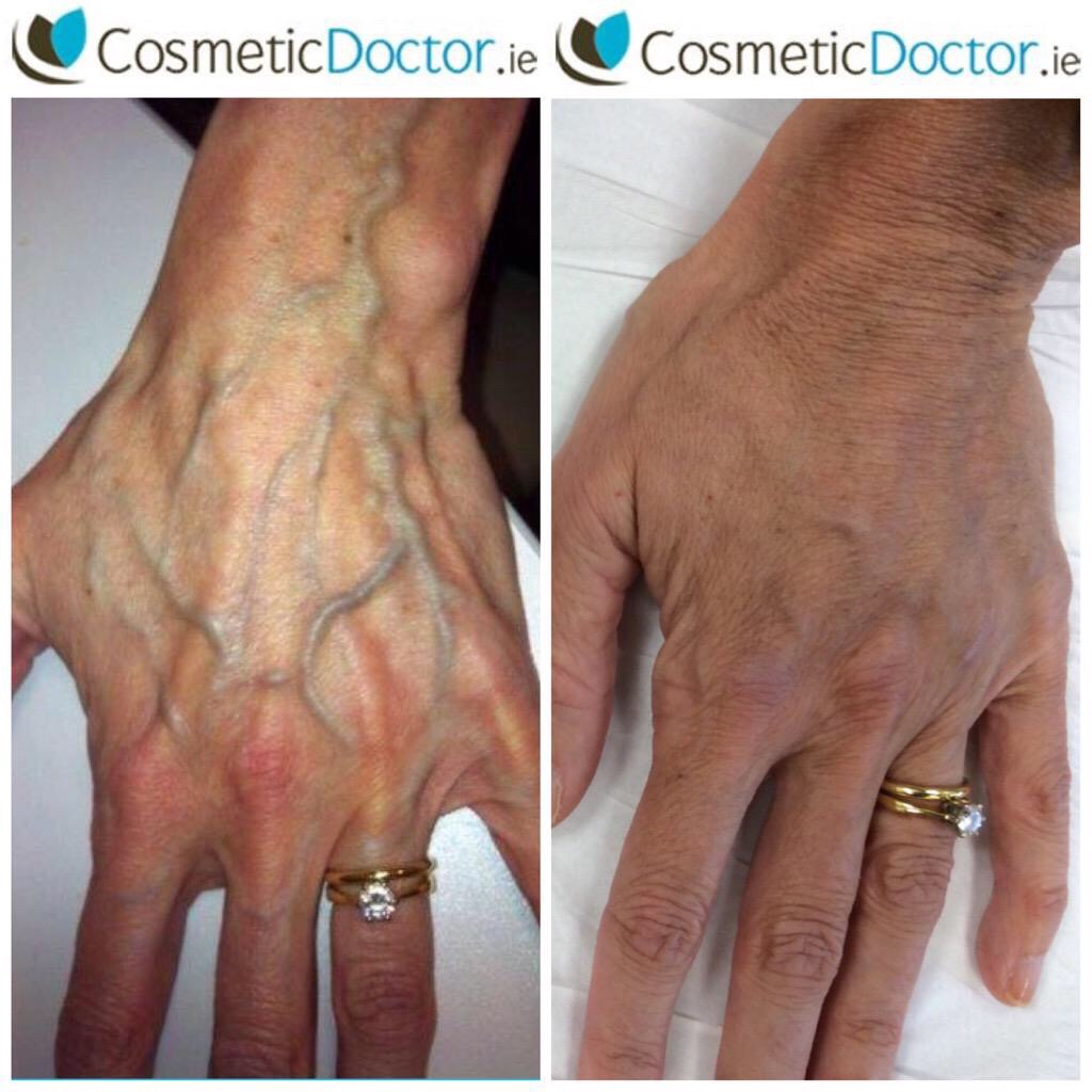 Radiesse hand rejuvenation before and after pictures 