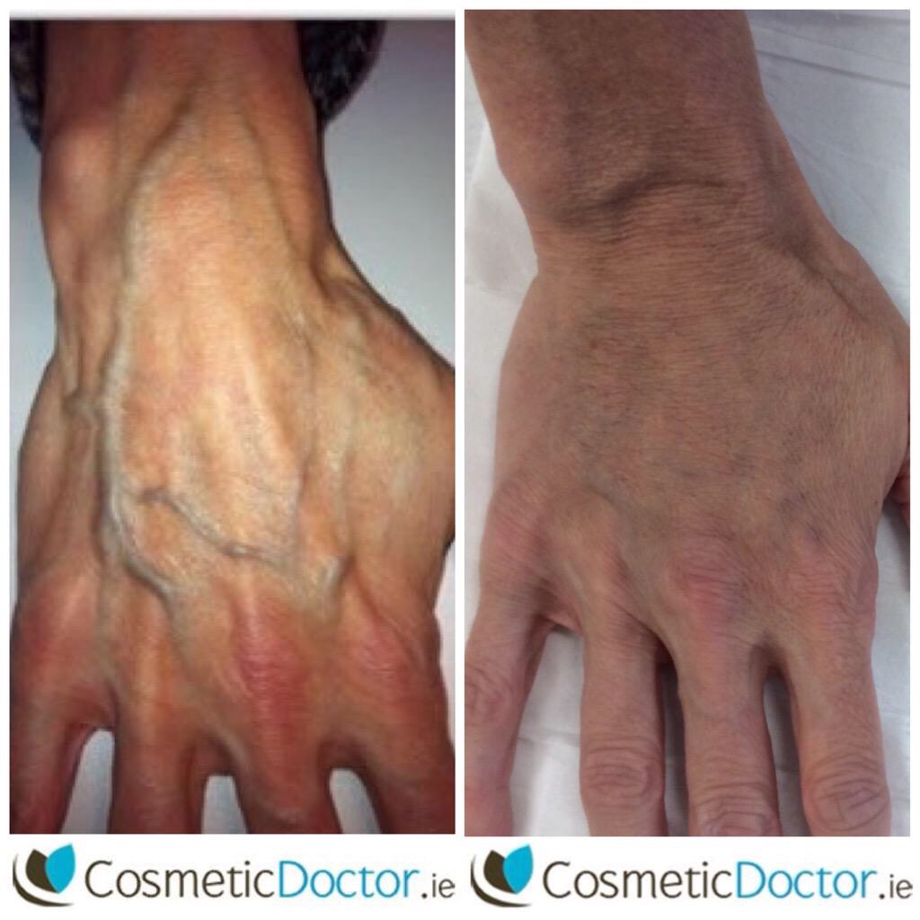 Radiesse hand rejuvenation before and after pictures