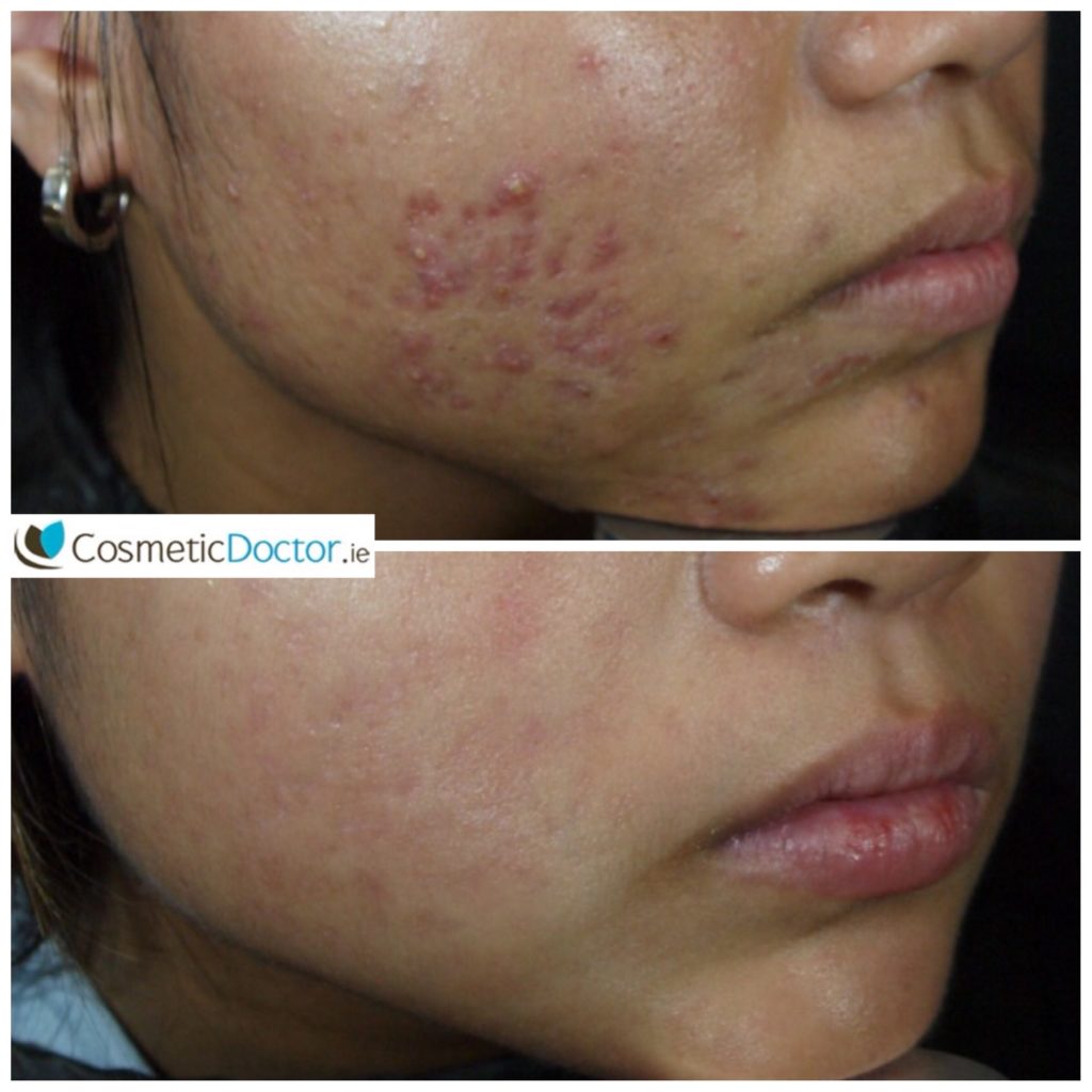 ZO Medical and Roaccutane for Acne and Acne Scarring 