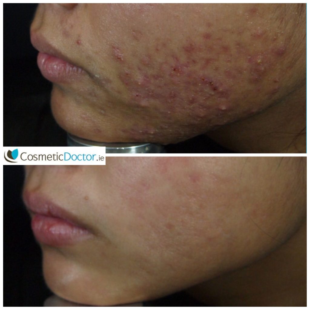 ZO Medical and Roaccutane for Acne and Acne Scarring