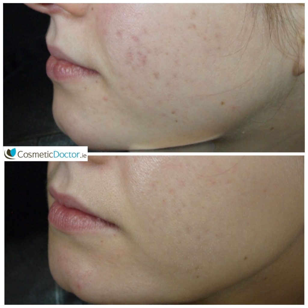 intracel acne scarring after 2 treatments and ZO Medical treatment