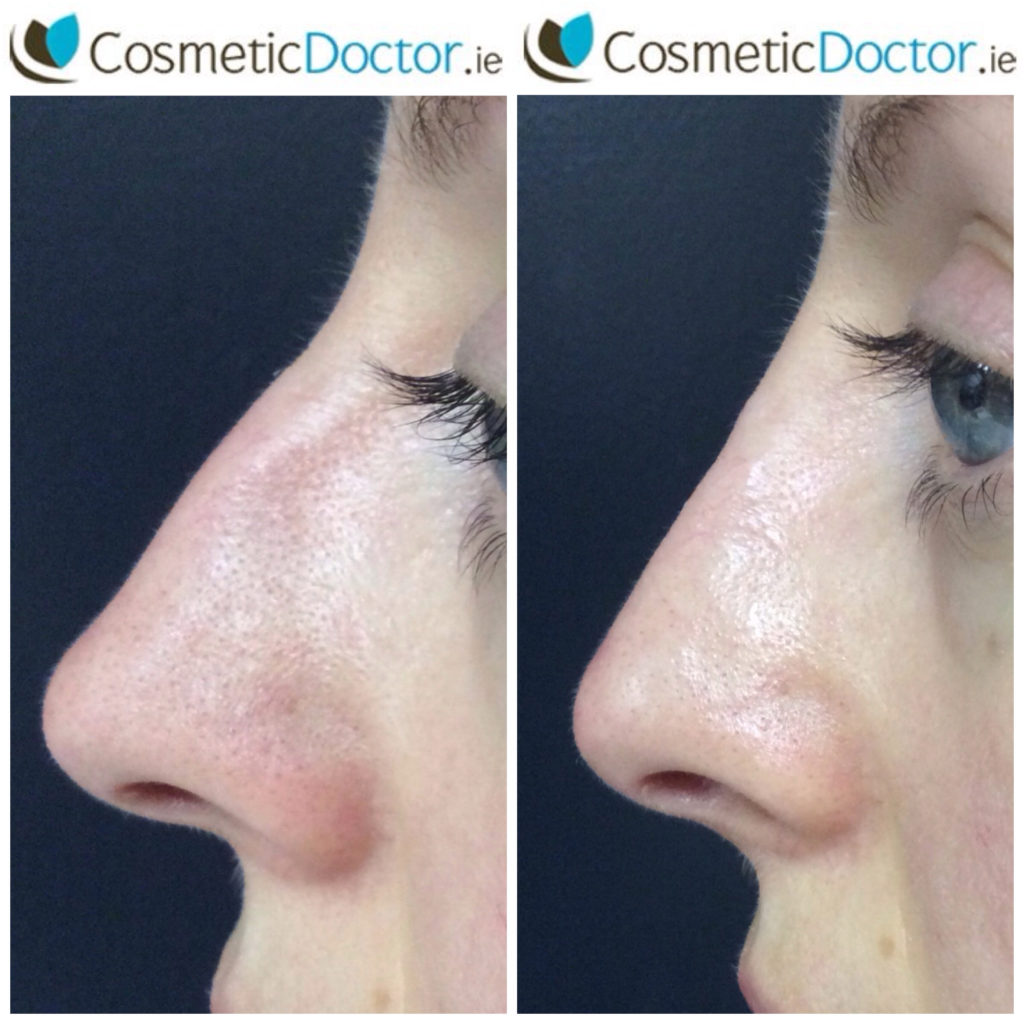 non- surgical rhinoplasty using dermal fillers