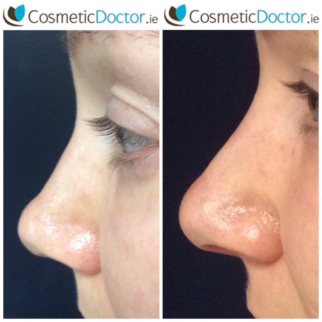 non- surgical rhinoplasty using dermal fillers