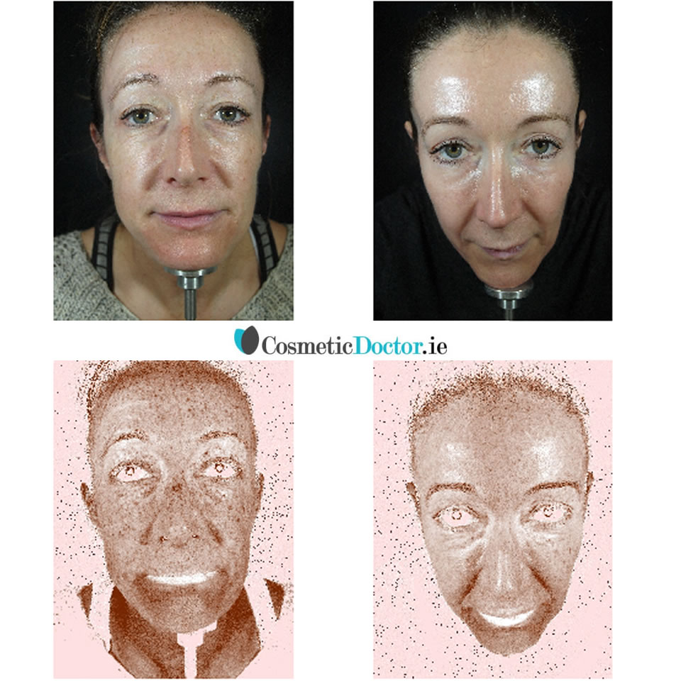 Before And After Zo With Retinol Skin Brightener and Wrinkle and Texture Repair System