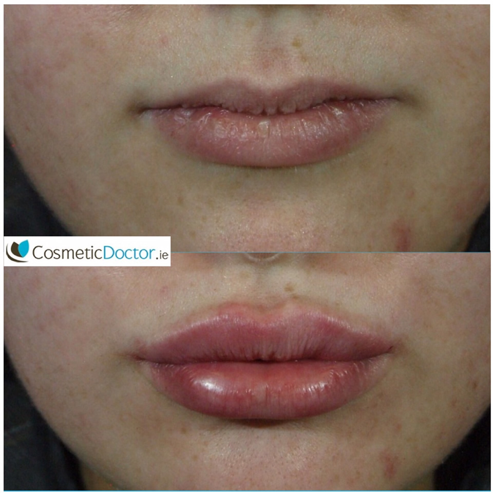 before_after_lip_fillers2_f16