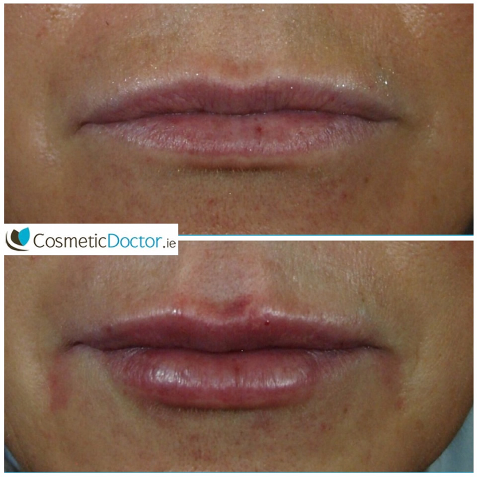 before_after_lip_fillers3_f16