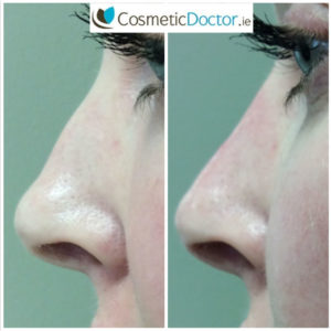 Before and after a non surgical nose job