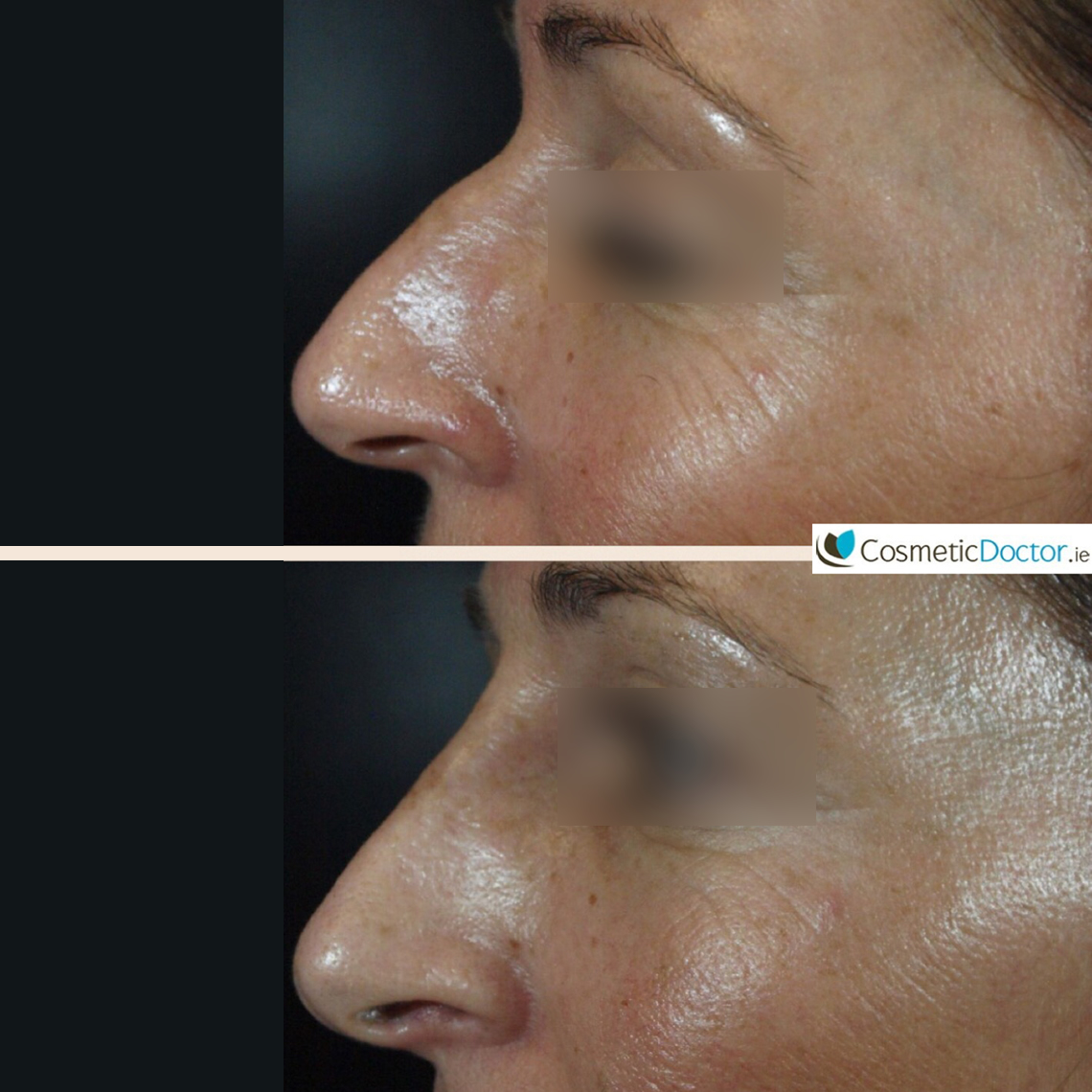Before and after non-surgical rhinoplasty