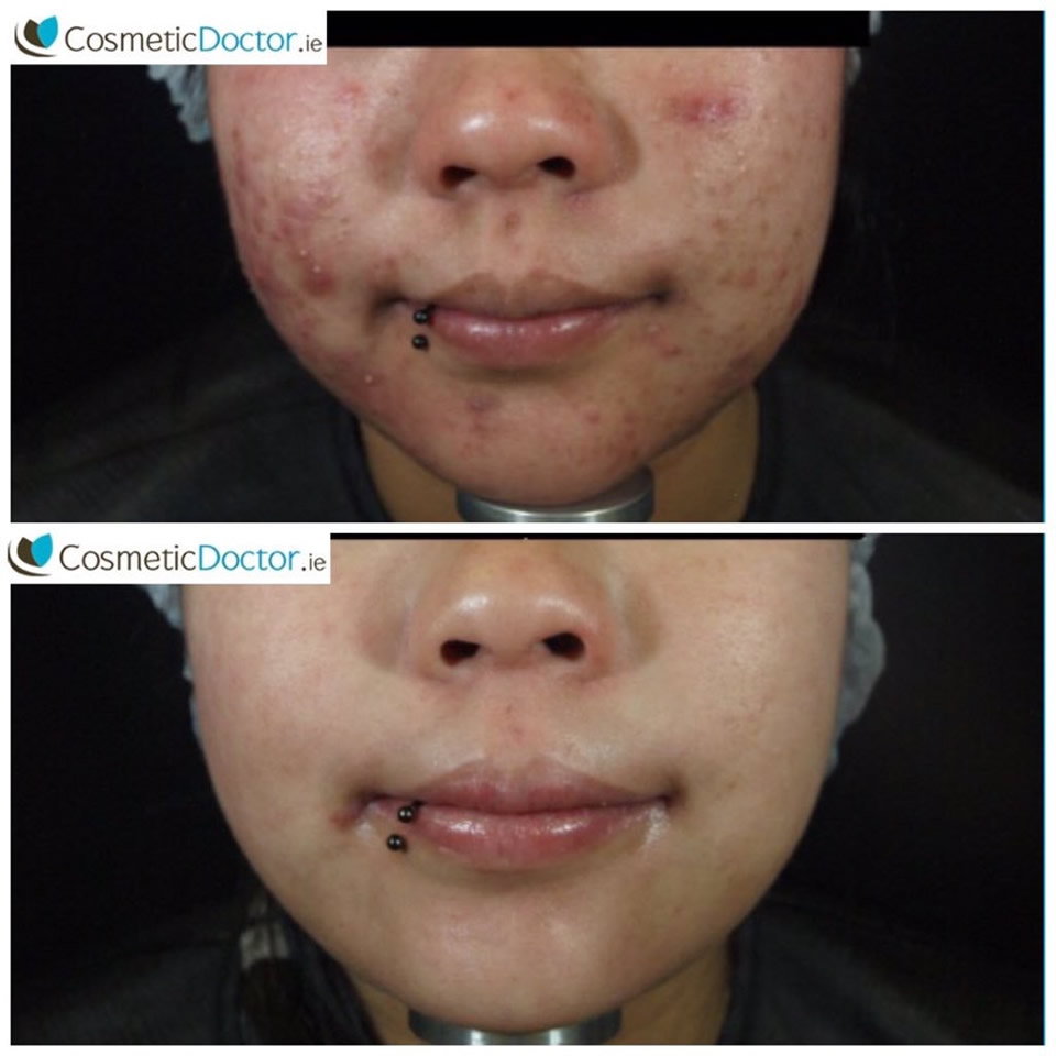 Before and after Roaccutane and Zo Medical for acne