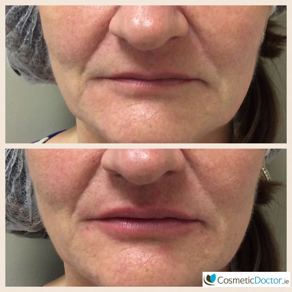 lip-augmentation-before-after