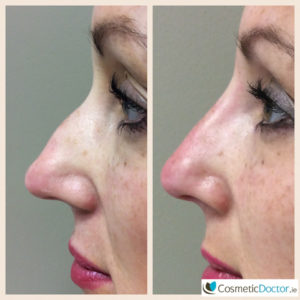 Before and after non surgical rhinoplasty
