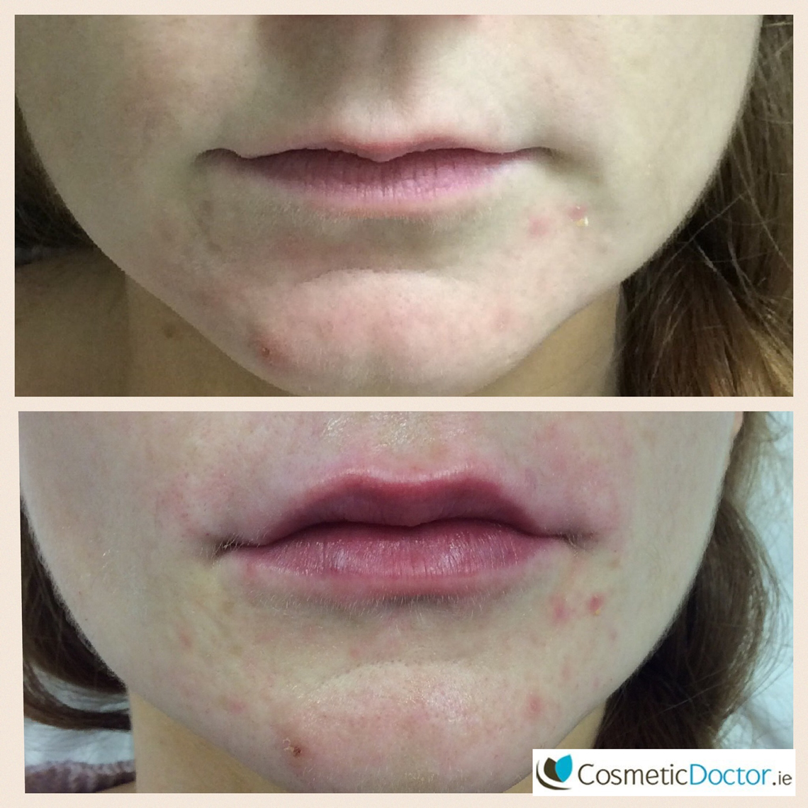 Before and after Lip fillers Dublin