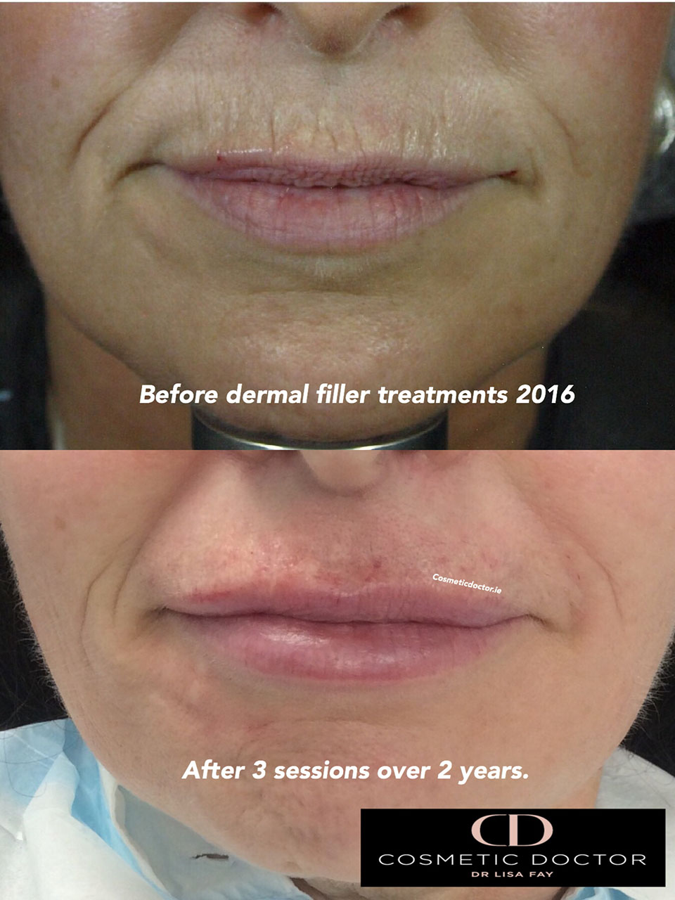 dermal fillers for lip enhancement results
