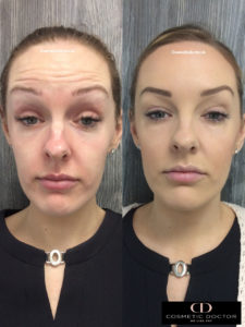 before and after Botox for forehead lines