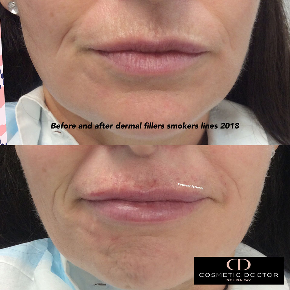 Before and after lip fillers for smokers lines