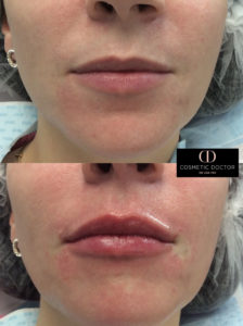 Lip augmentation results