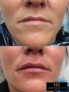 Lip enhancement results
