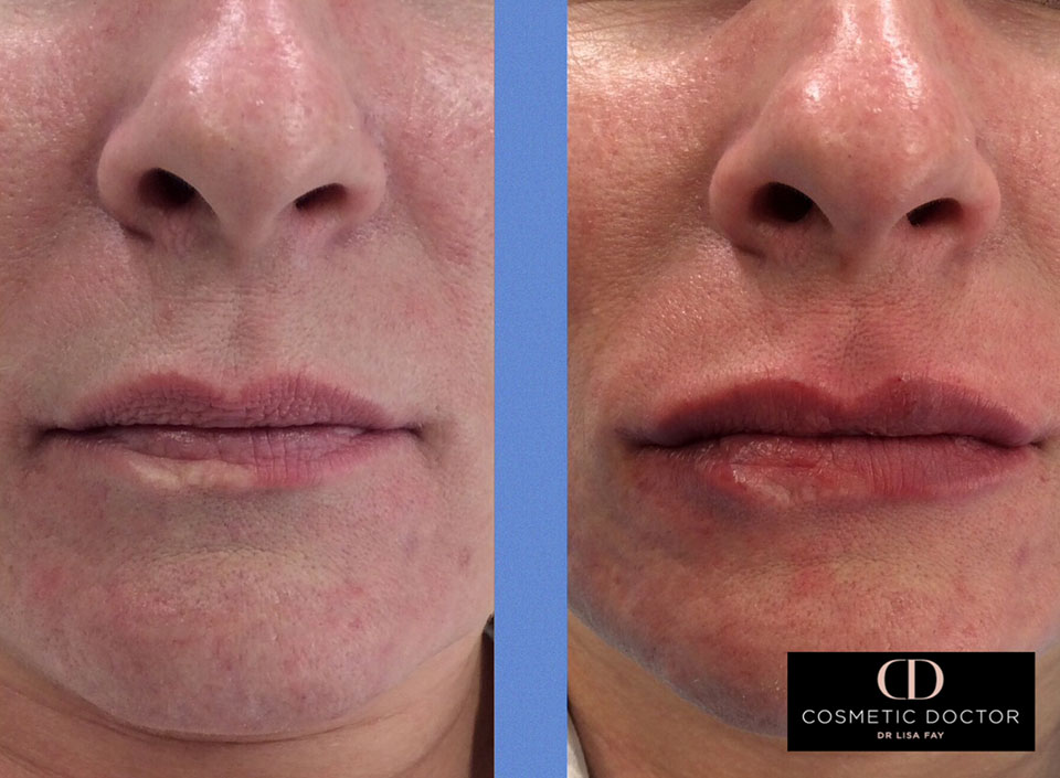 Lip enhancement results using dermal fillers