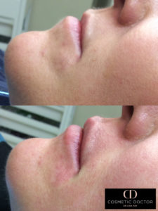 lip enhancement results